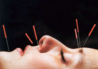 Acupuncture_Facelift.png