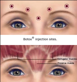 botox-injection-sites.png