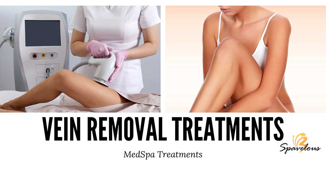 vein removal treatments