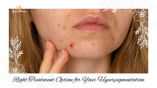 hyperpigmentation and acne