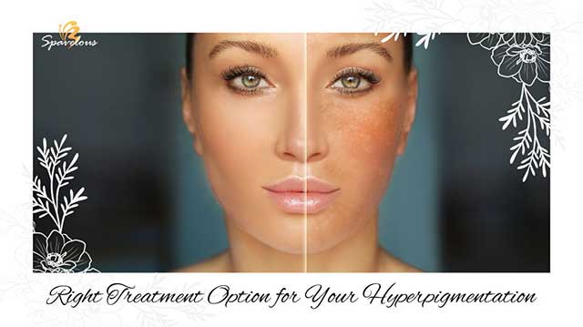 managing hyperpigmentation