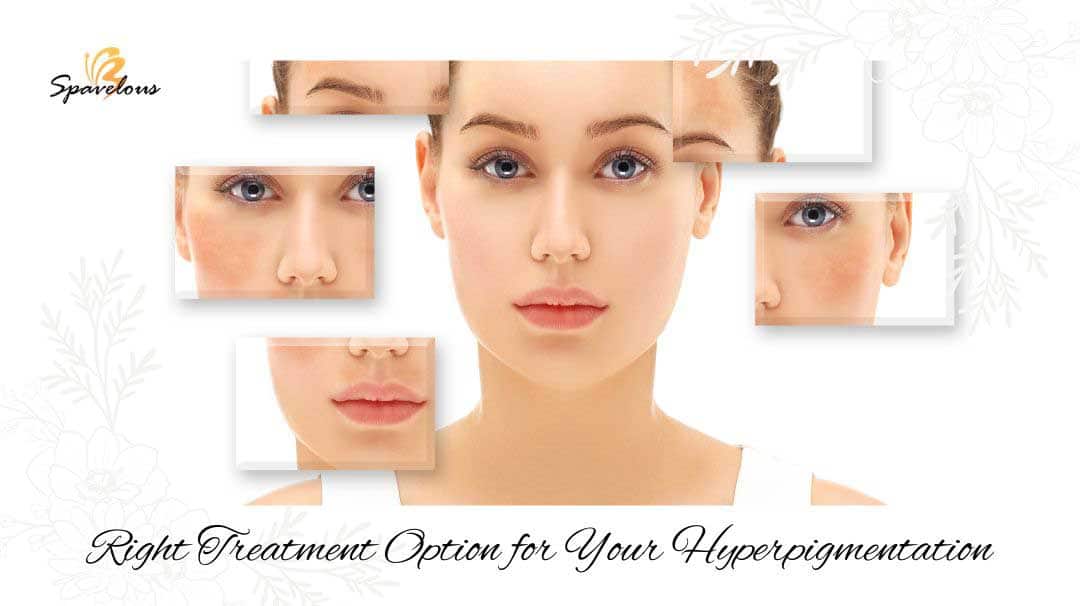 right treatment option for your hyperpigmentation