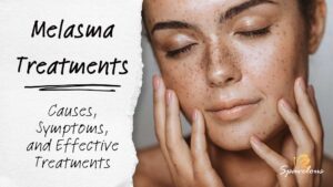 melasma treatments