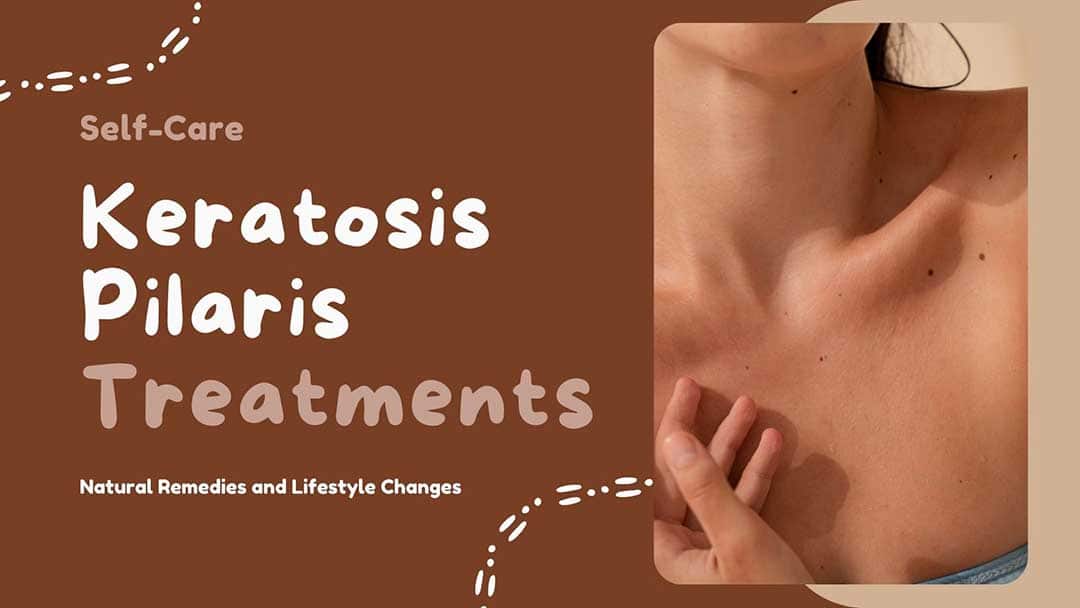 keratosis pilaris treatments