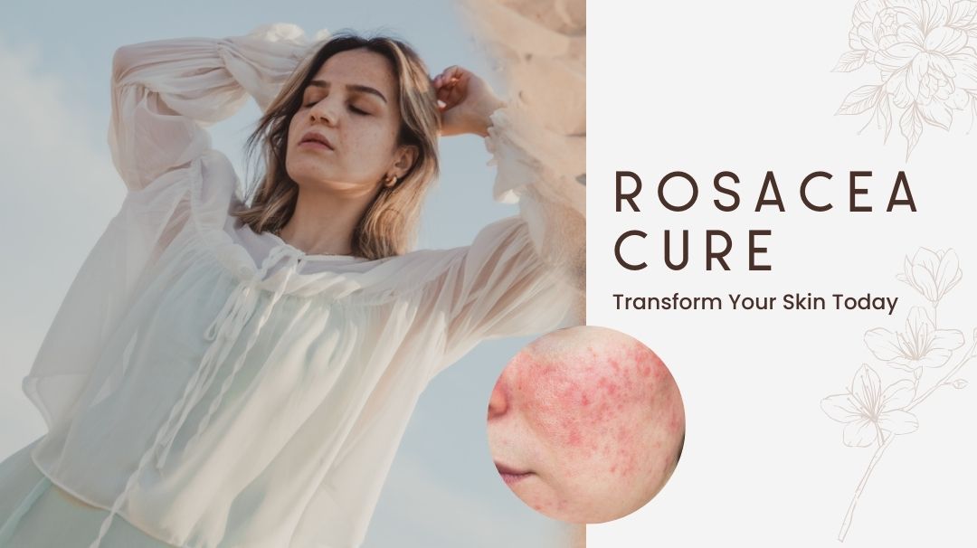 rosacea cure transform your skin today